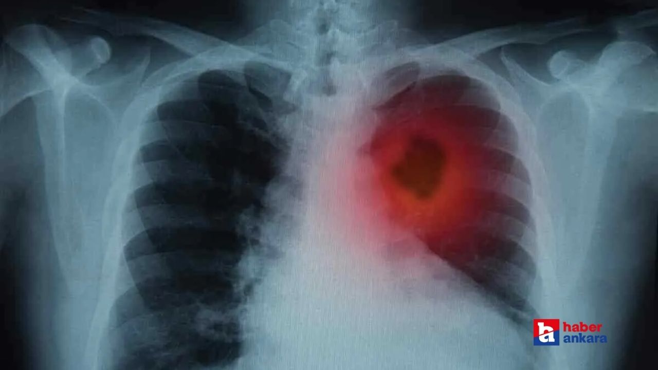 Bu 3 belirtinin en sinsi akciğer kanseri belirtisi olduğu ortaya çıktı